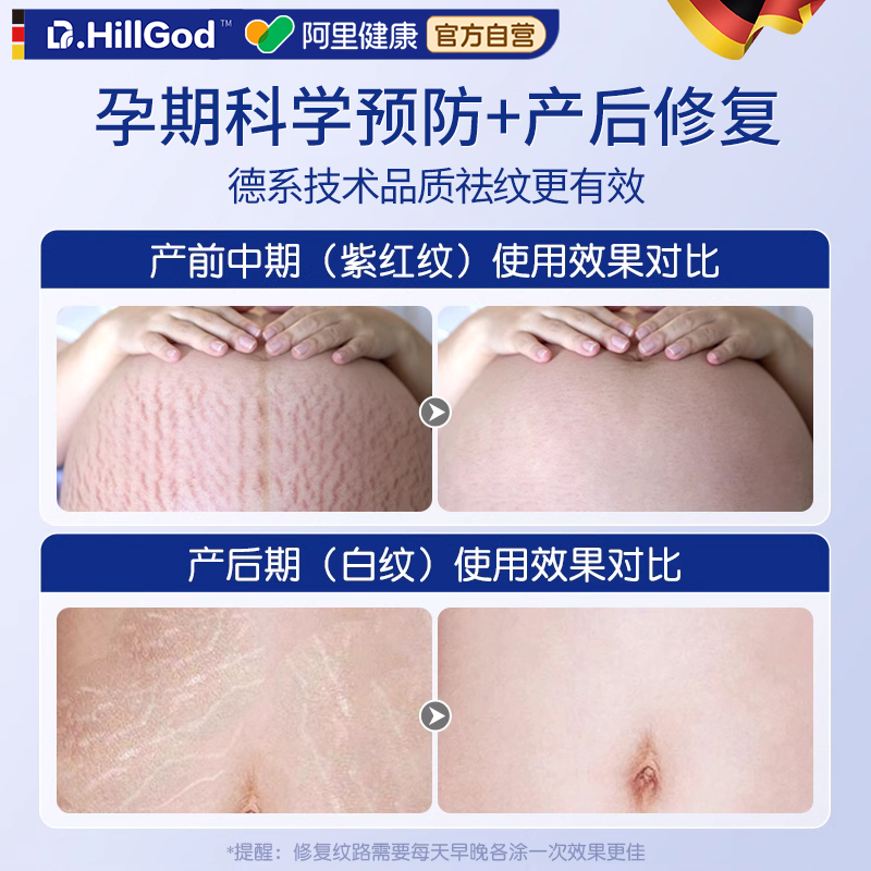 为什么会出现肥胖纹？如何预防和改善？
