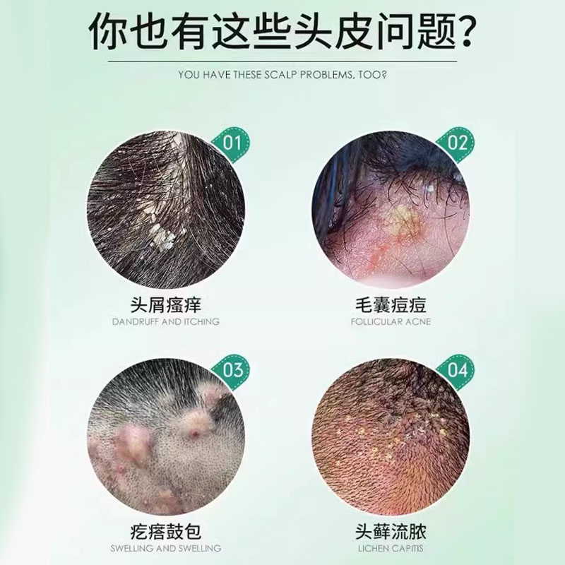 头皮屑多是什么原因造成的？怎么办才能摆脱困扰？