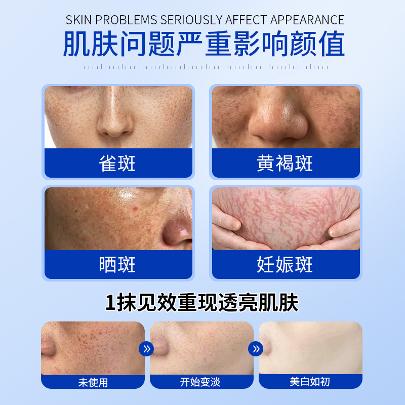 黄褐斑怎么治疗最有效?快速改善肤色的秘诀