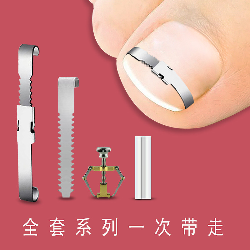 什么情况下需要使用【一按一贴】甲沟嵌甲指甲矫正器？