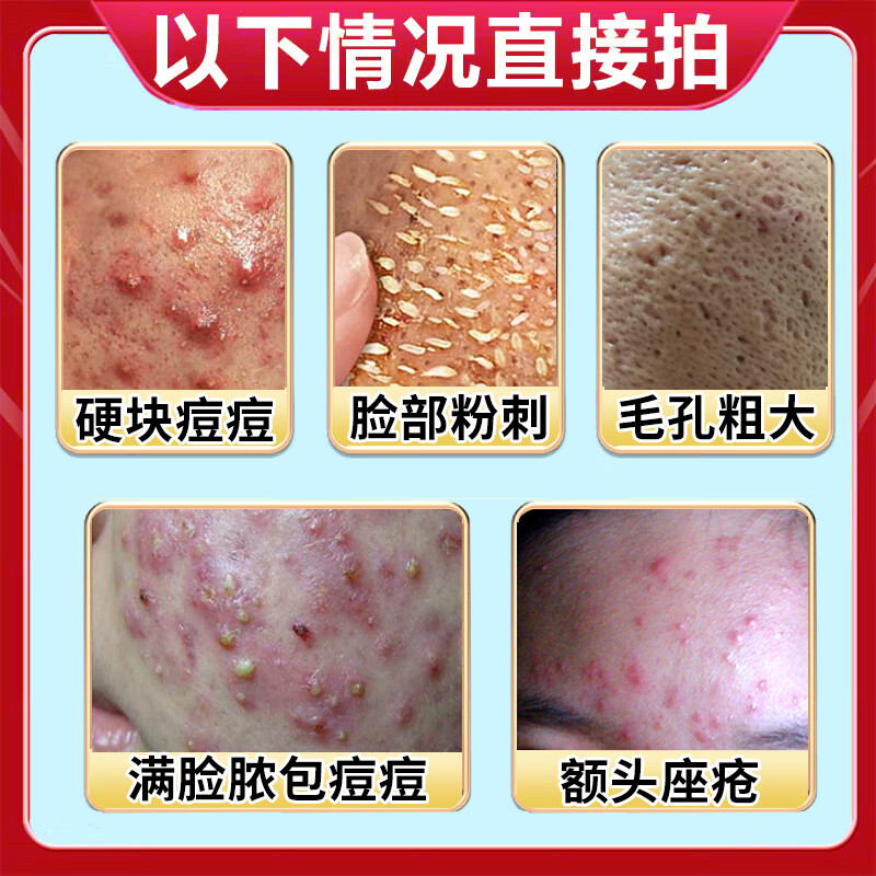 鑫合康伊逗医痘凝胶：告别痘痘，重拾自信✨