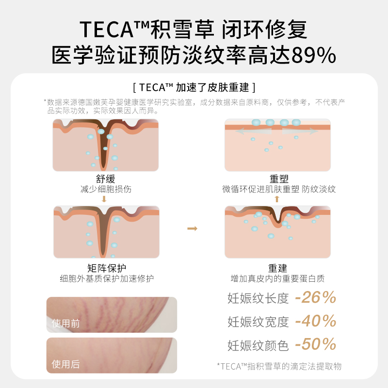妊娠纹能治好吗？拯救孕妈的终极秘籍来了！