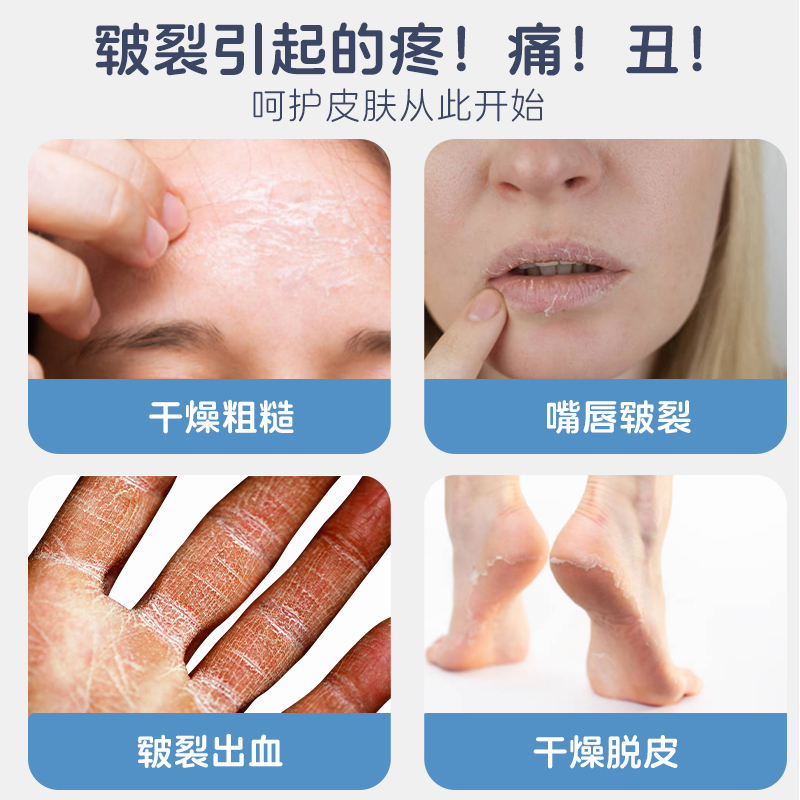 医用甘油身体乳：告别干裂，拥抱水润，肌肤保湿新革命！