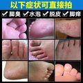 脚上起水泡痒气脱皮止痒杀菌？脚丫子痒烂怎么办？脚趾缝烂痒全攻略！