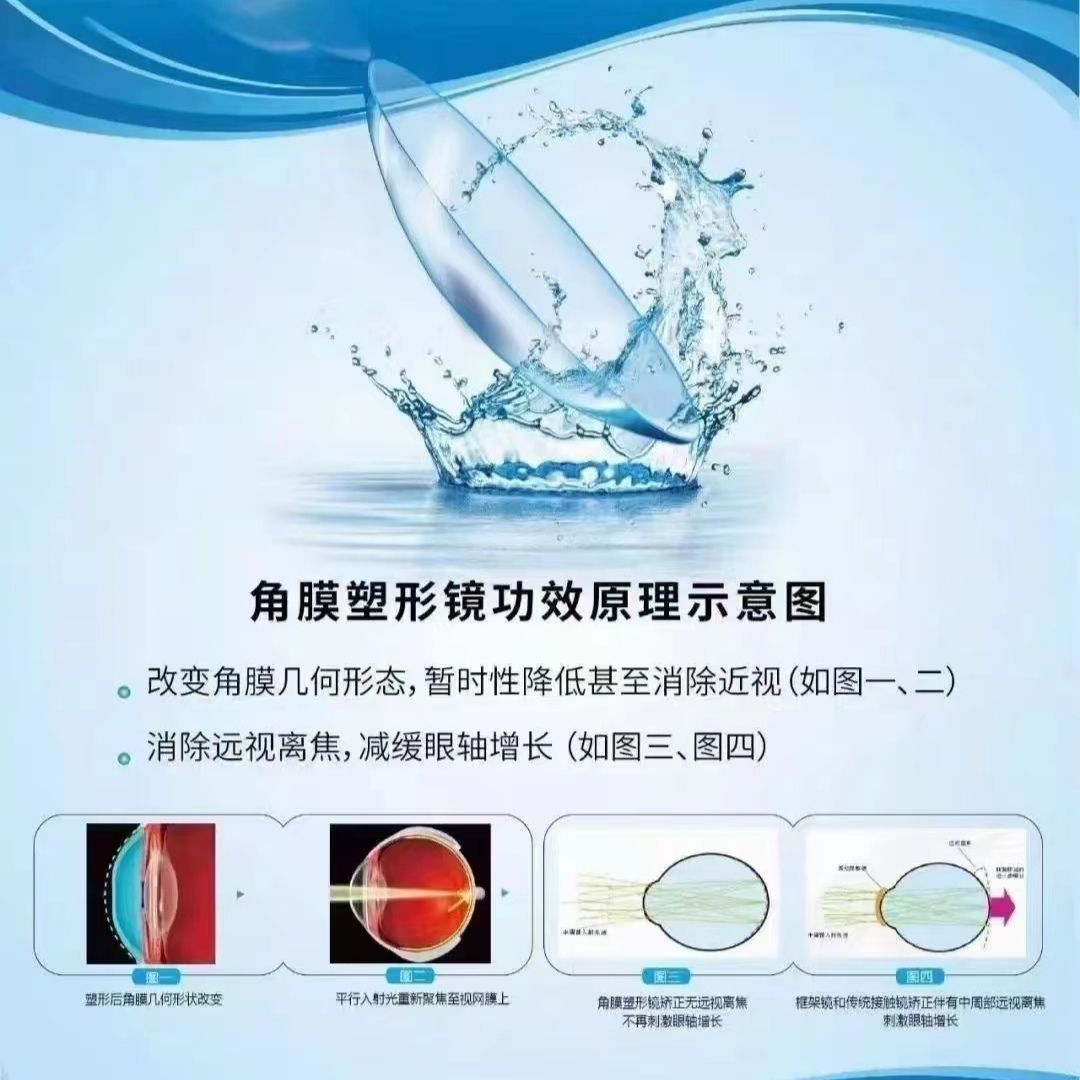 定制OK镜，补片换镜：近视防控新潮流，你get了吗？