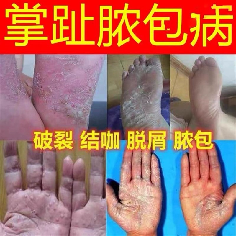掌趾脓疱病专用药膏：告别红斑脱皮，恢复健康肌肤