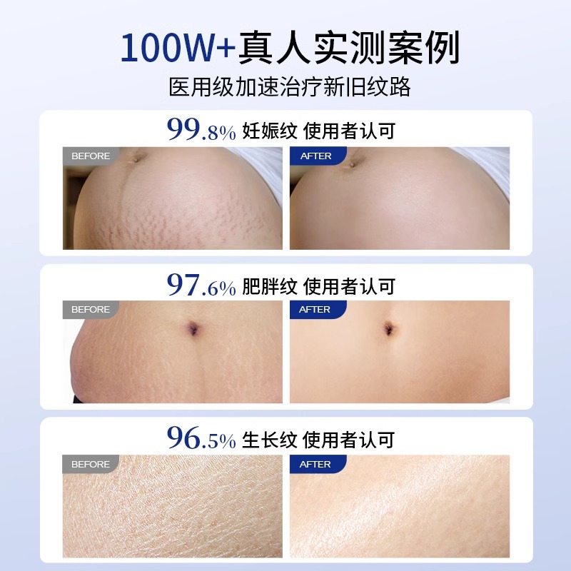怀孕几个月会长妊娠纹？如何预防和护理？