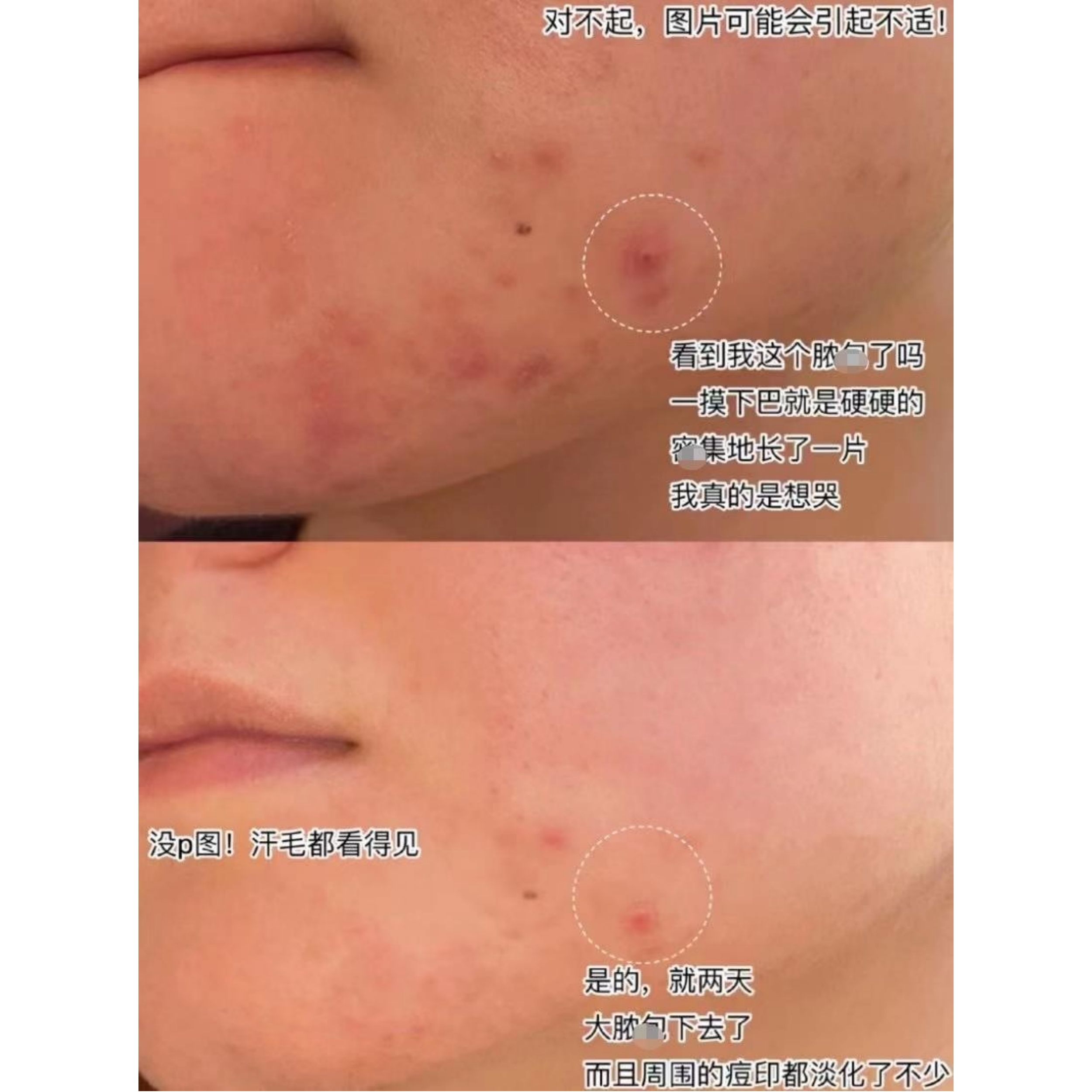 MALIN+GOETZ马林狗子夜间净痘精华14ML：闭口红肿痘的救星？