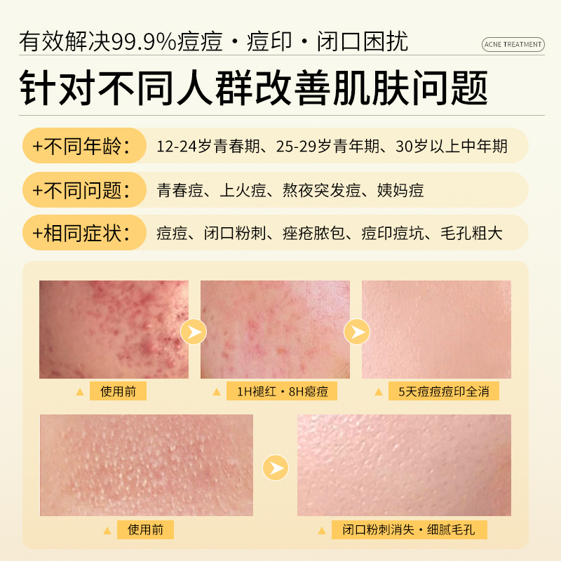 祛痘最好的方法，目前最有效的！绝绝子，拯救你的面子问题！