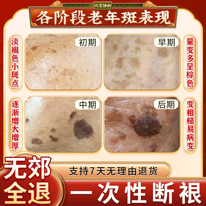 老年斑消除最好的方法是什么？用什么药效果好？