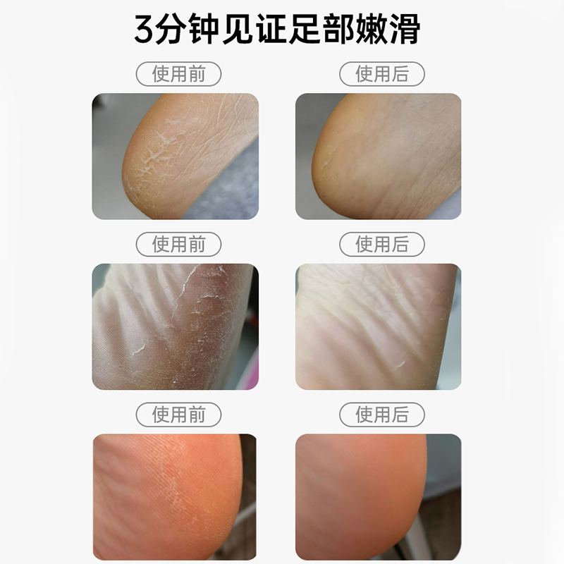 电动修脚器：告别手动烦恼，一键享受脚部SPA！
