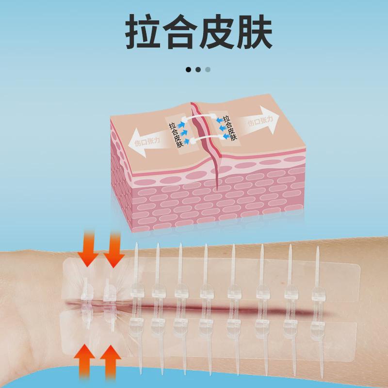 医用皮肤伤口免缝减张贴：剖腹产疤痕减张器与甲状腺术后拉链创口贴，轻松告别难看疤痕！
