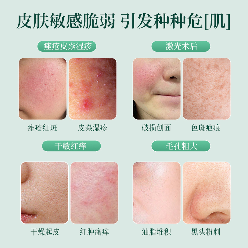 济百珍医用敷料：痤疮、玫瑰痤疮、脂溢性皮炎患者的透明质酸钠修复神器！