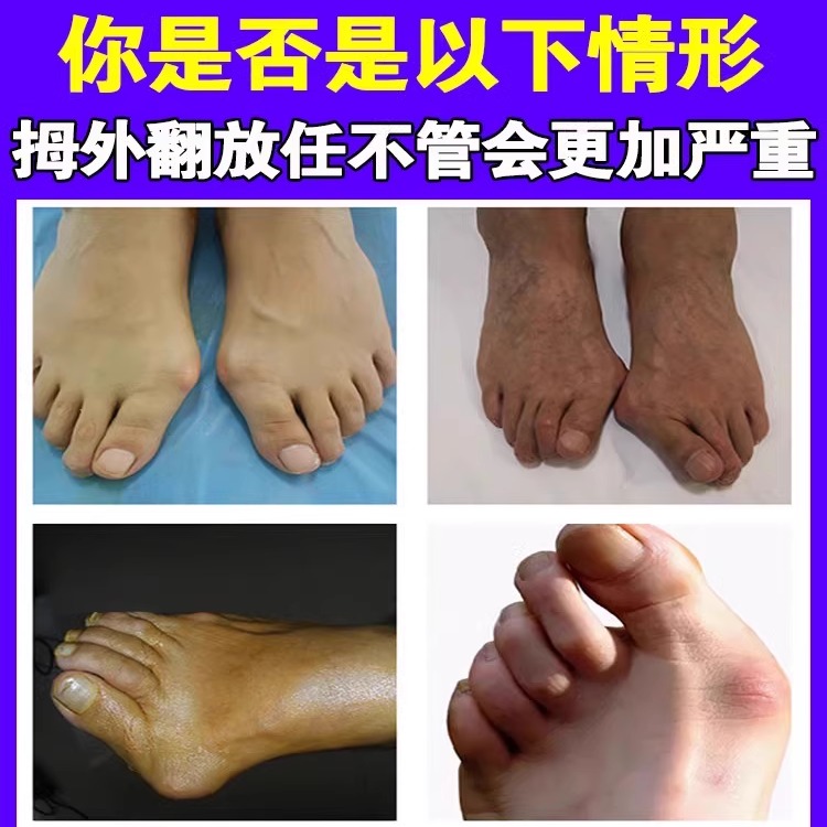 告别大脚骨，【100%灭大脚骨】矫正贴，轻松矫正脚趾重叠问题！