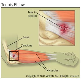 Tennis Elbow2011 1.0 Build 71