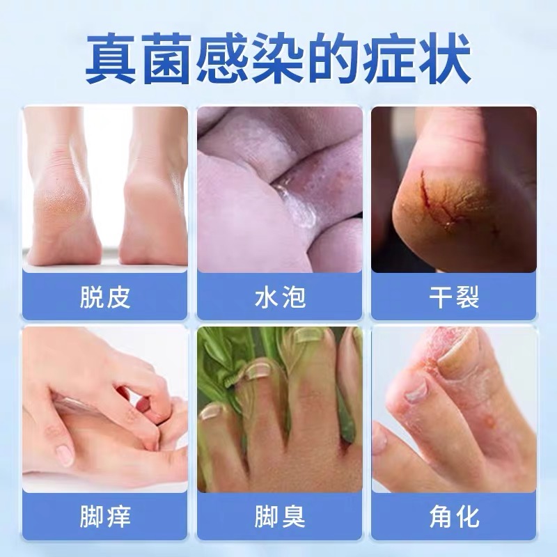 告别脚气烦恼，特效药让你重获新生！