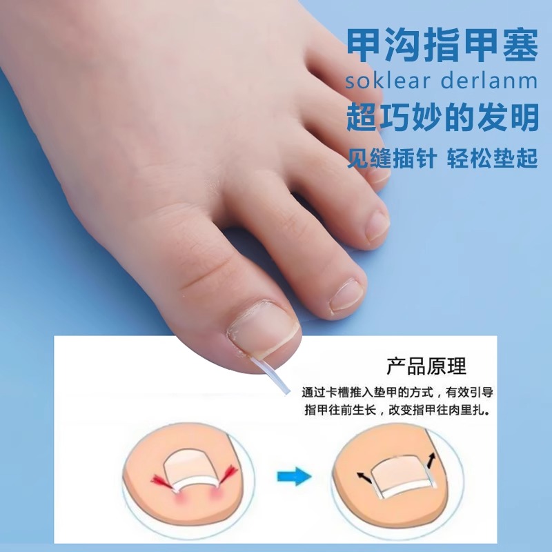 告别疼痛！甲沟矫正器贴片炎嵌甲神器，防脚指甲往肉里长专用隔离工具填充垫片