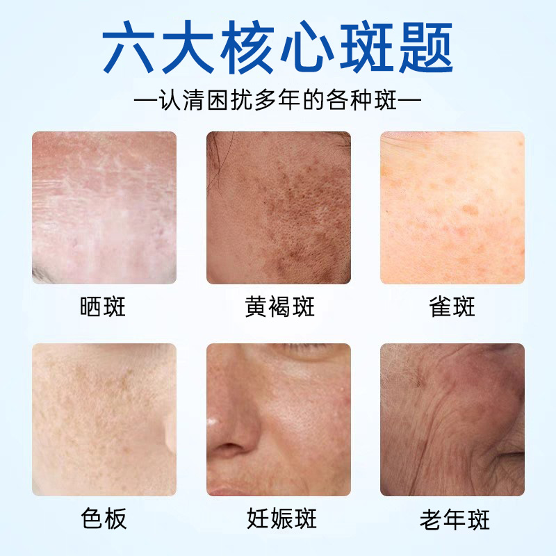 别再忽视啦！手部老年斑对比图告诉你真相，拯救你的“时光痕迹”