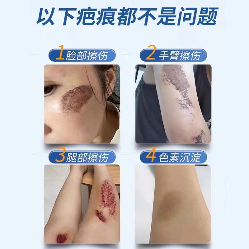 胸前疤痕增生凸起去除大法：除疤膏遮盖神器，告别疤痕疙瘩！