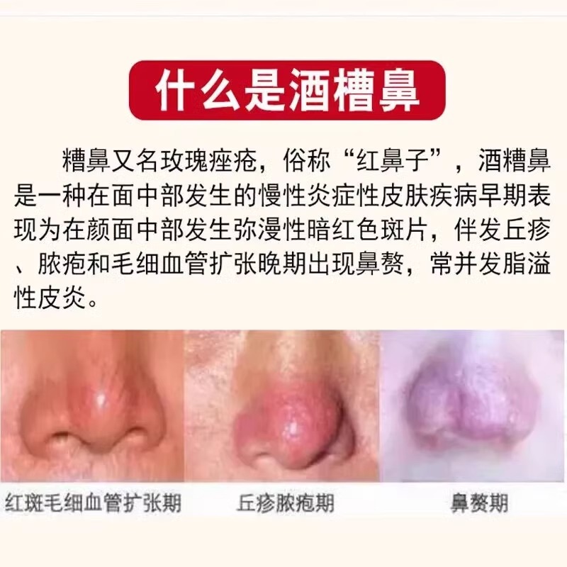为什么会出现酒糟鼻、草莓鼻和红鼻子？如何改善这些问题？