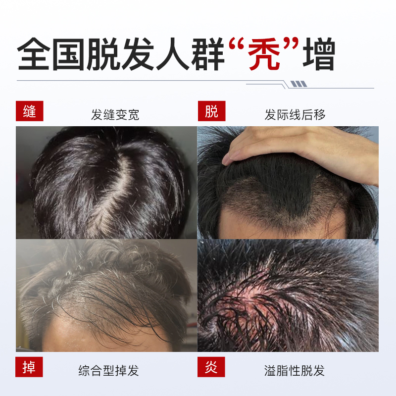 脂溢性脱发救星！水非米诺地尔生发中药洗发露，告别秃头危机
