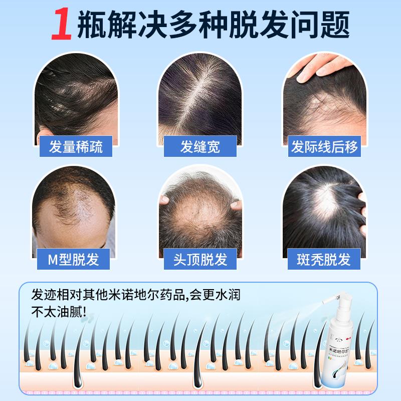 发迹米诺地尔酊搽剂5%：告别脱发，重获浓密秀发的终极秘籍✨