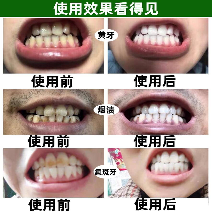 牙结石去除大作战：揭秘牙渍黄牙清理神器，洗牙污垢速效溶解秘籍！
