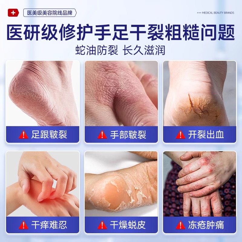 蛇油膏手脚裂膏：冬季防冻神器，告别手脚干裂，保湿滋润新体验！