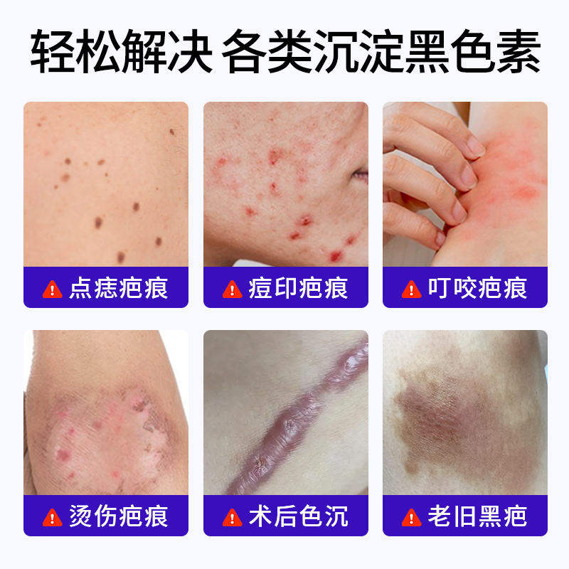 祛疤的最佳方法有哪些？如何科学选择适合自己的方式？