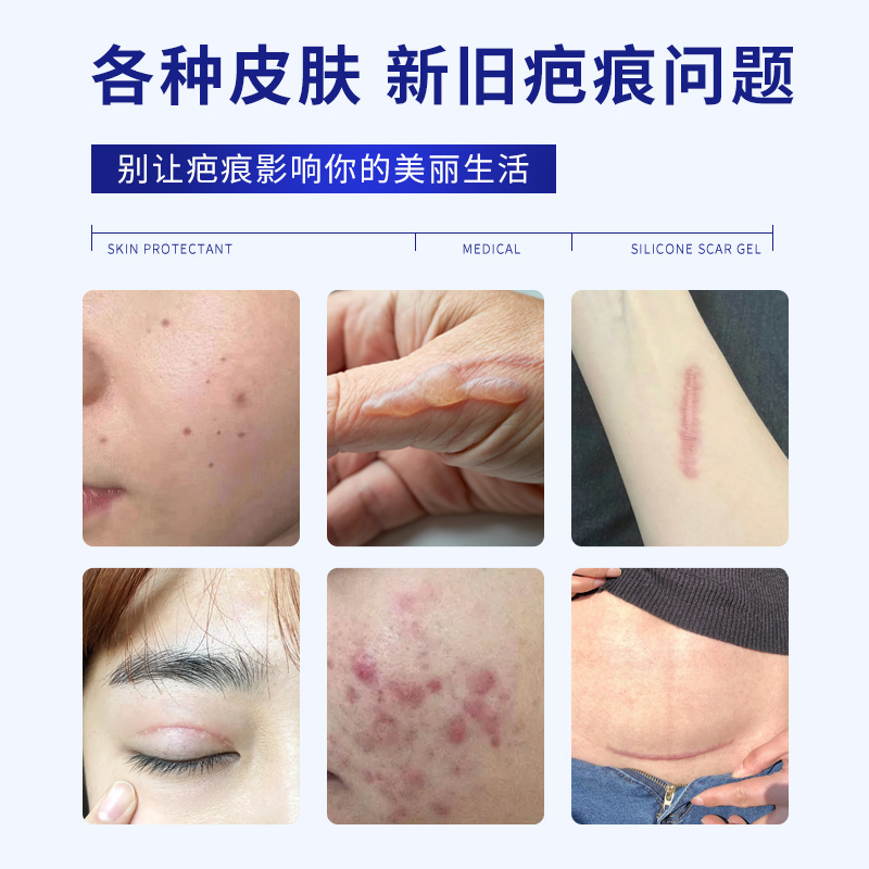 杰生康祛疤膏：剖腹产手术增生、儿童烫伤去除疤的秘密武器？