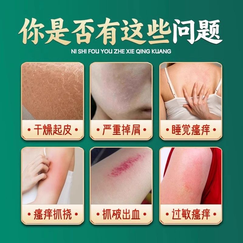 日本止痒王真的能救我！干痒瘙痒一涂就停？这波不冲亏麻了