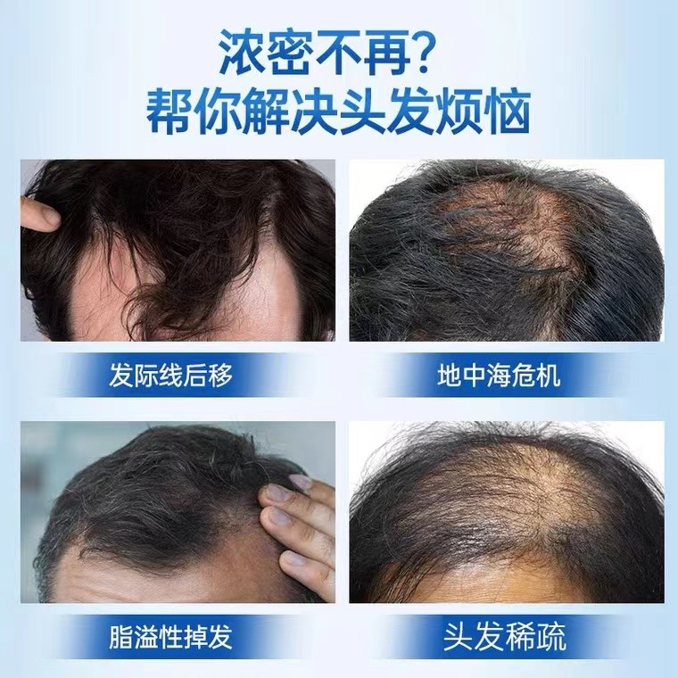 脱发用什么药物治疗？米诺地尔真的有效吗？