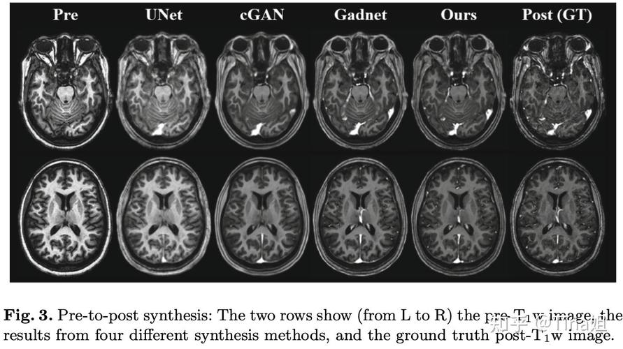 oms multiple sclerosis,Understanding OMS Multiple Sclerosis: A Comprehensive Guide