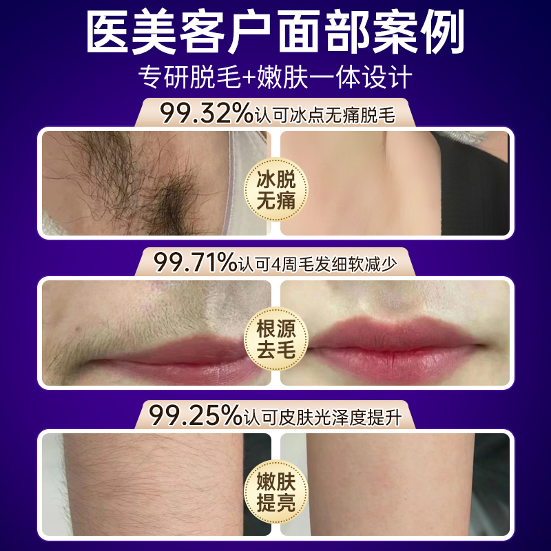 激光脱毛仪真的可以永久脱毛吗？效果如何保证？