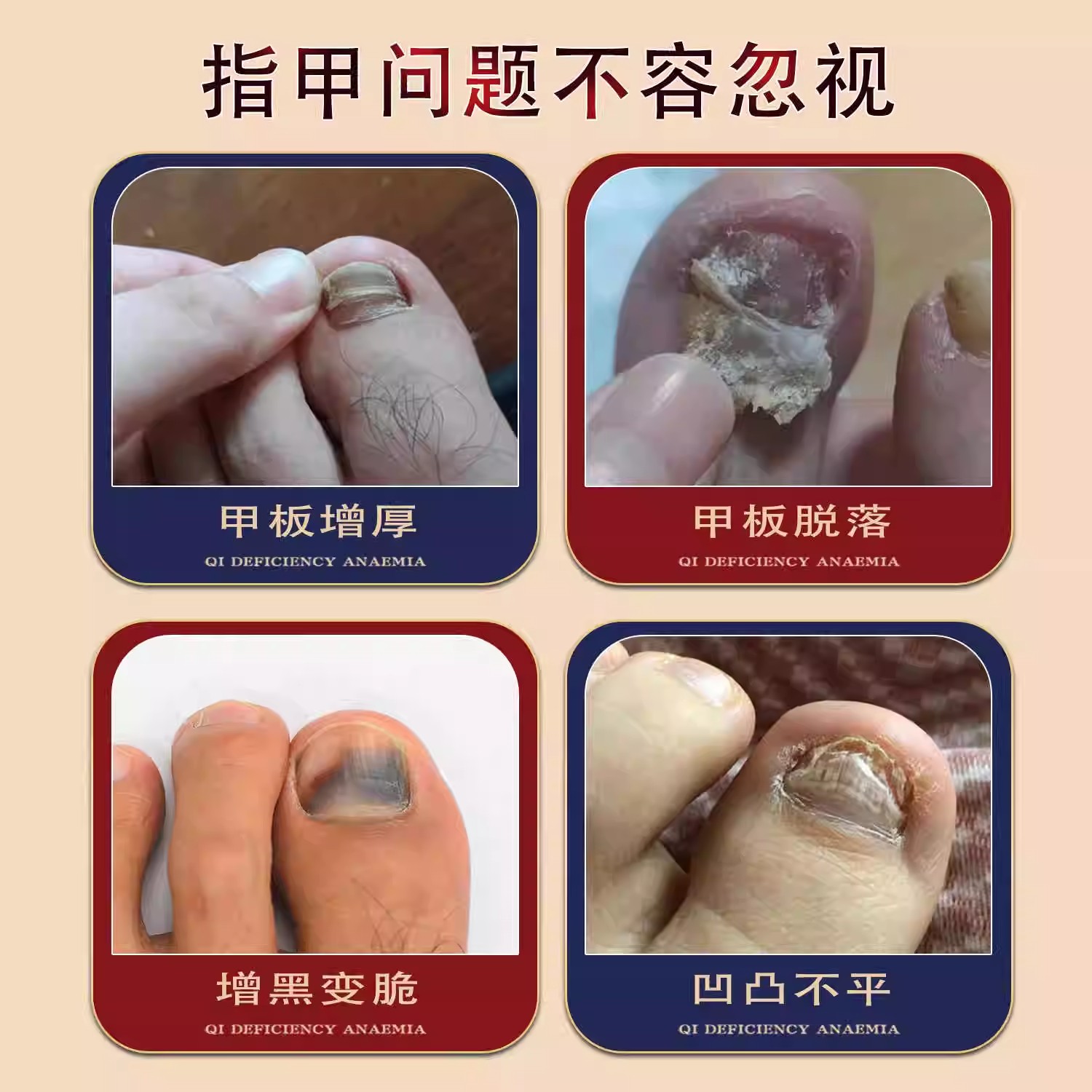 凤仙花灰指甲抑菌液膏，香港大药房推荐，告别灰趾烦恼