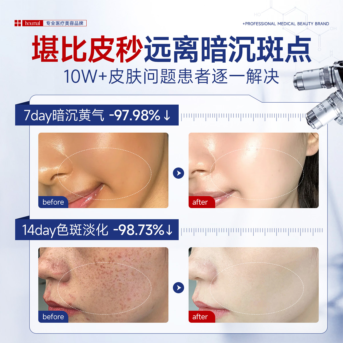 治疗雀斑需要多少钱？价格影响因素全解析