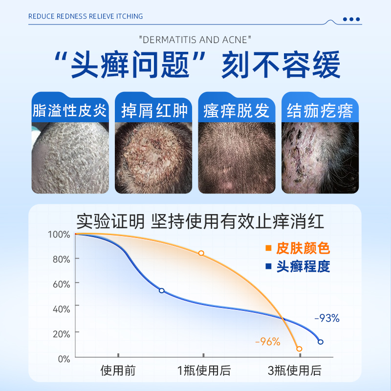 头皮屑多是什么原因引起的？如何科学调理改善？
