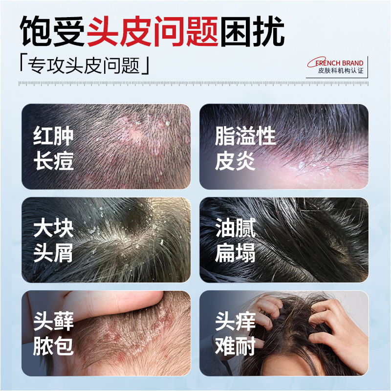 头皮屑大块能扣下来再洗头发吗？正确处理方法