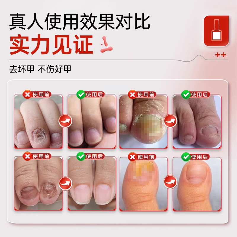 正品灰指趾甲草本抑菌液：拯救你的“丑甲”危机！