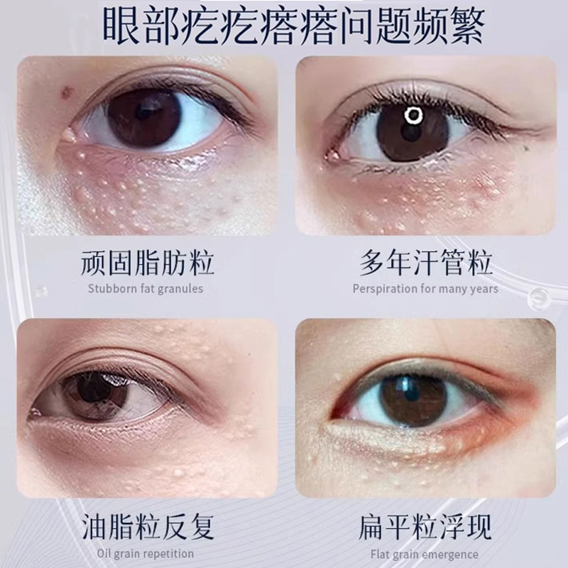 眼袋大按哪个穴位？宝藏养生指南，拯救你的眼部困扰！