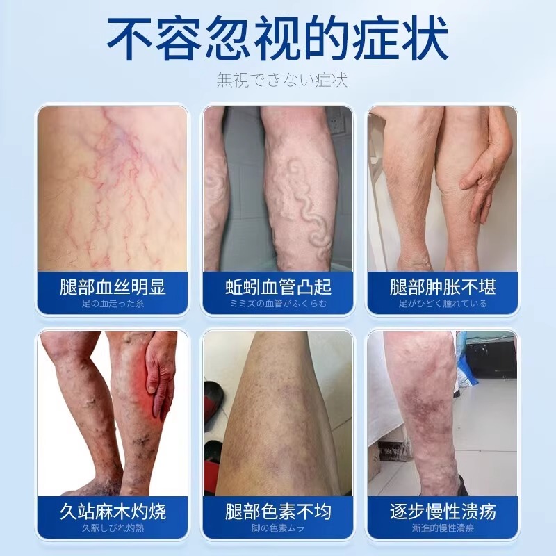 静脉曲张口服药大揭秘：中药下肢静脉血栓降血脂中成药绞股蓝总甙片100片，能否成为你的救命稻草？