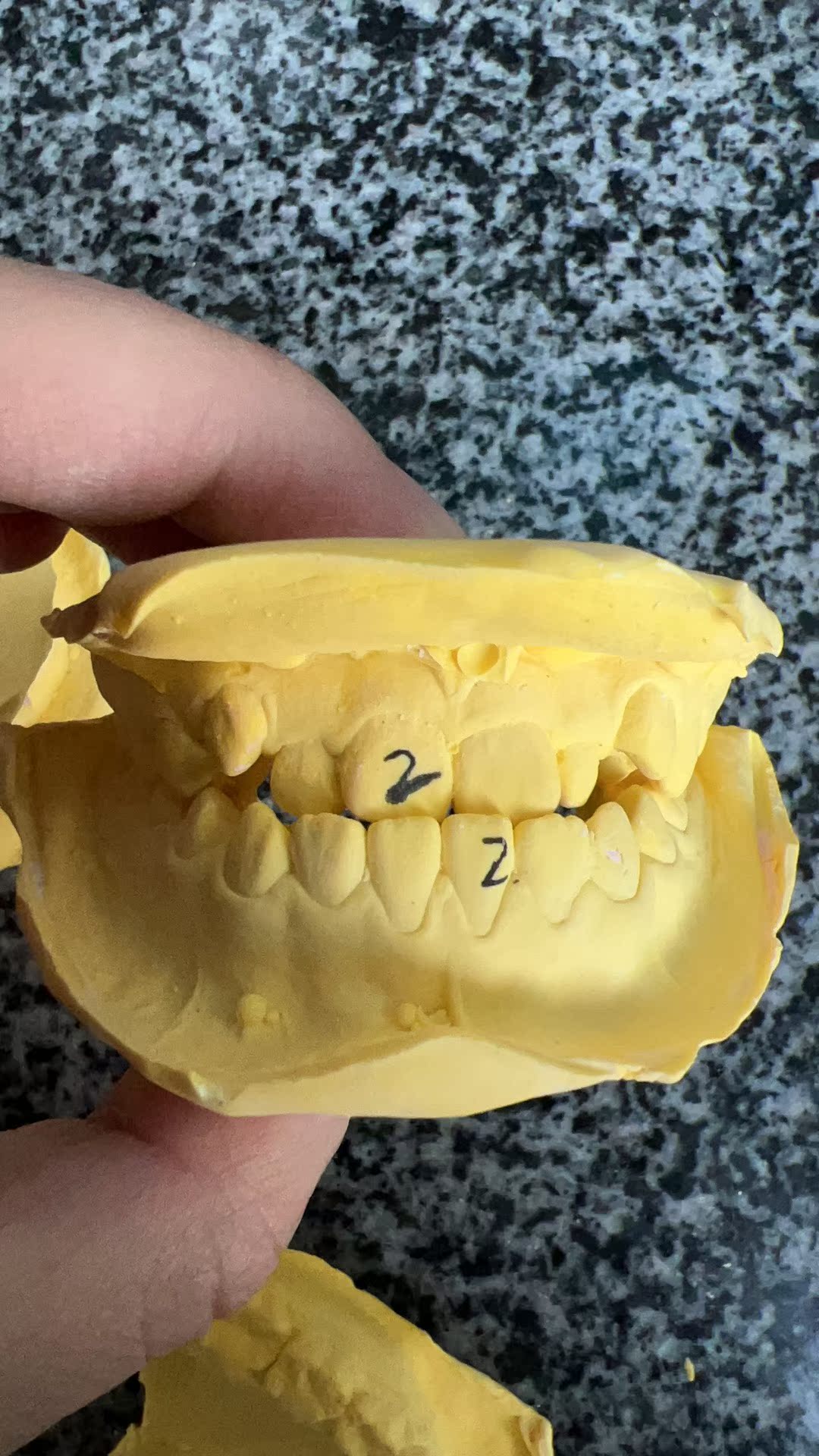 法兰克3儿童牙齿隐形矫正器：地包天、龅牙、深覆合、反颌矫正神器！