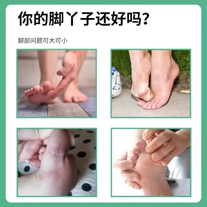 脚气脚痒脚上起小水泡？止痒脱皮专药杀菌膏来救场！