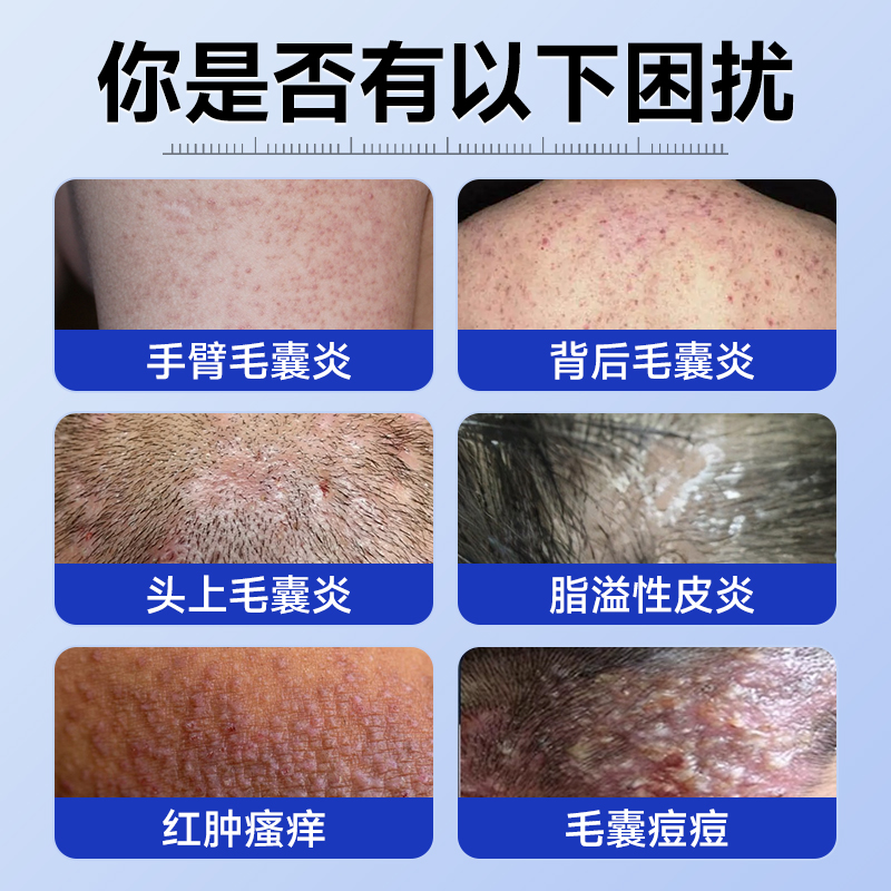 头皮毛囊炎长痘痘？这个药膏真的太顶了！治痒又去痘，油头星人必看