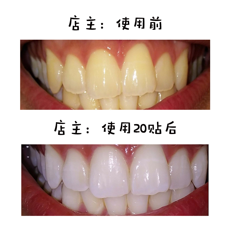 义获嘉璀璨瓷牙贴面：告别四环素牙，重塑自信微笑的秘密武器！