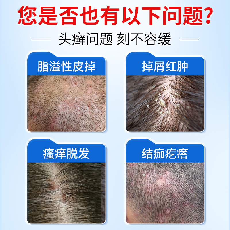 头皮屑怎么去除最快最有效？拯救你的头发和自信！