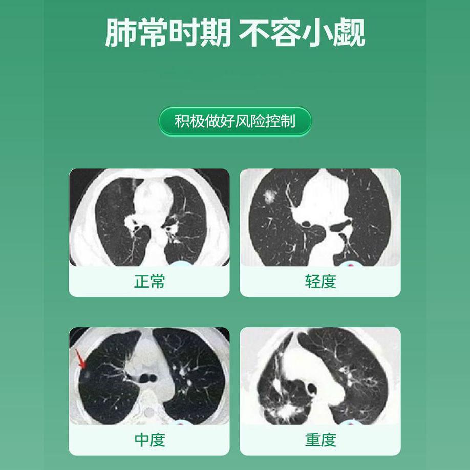 慢性咽扁桃体不适？罗汉果片能否成为你的救星？