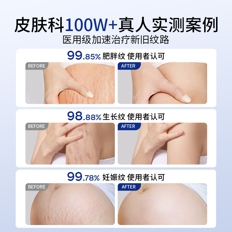 妊辰纹是什么时候开始出现？准妈妈必看的详细解答