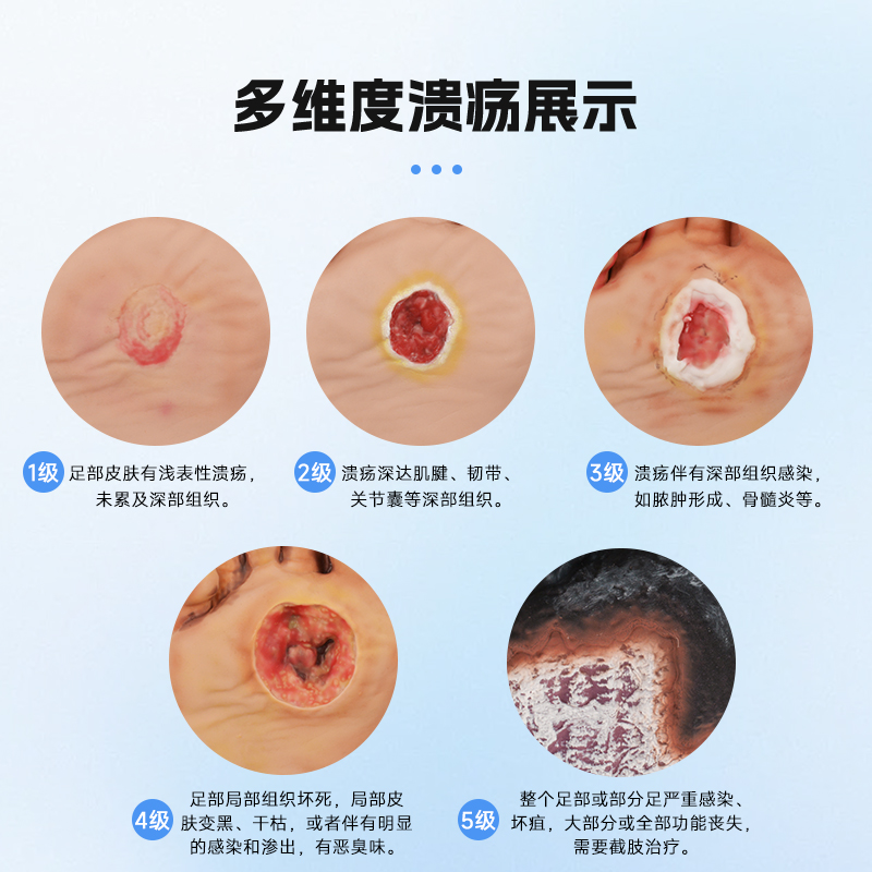 糖尿病足护理模型：守护老人健康的必备神器！