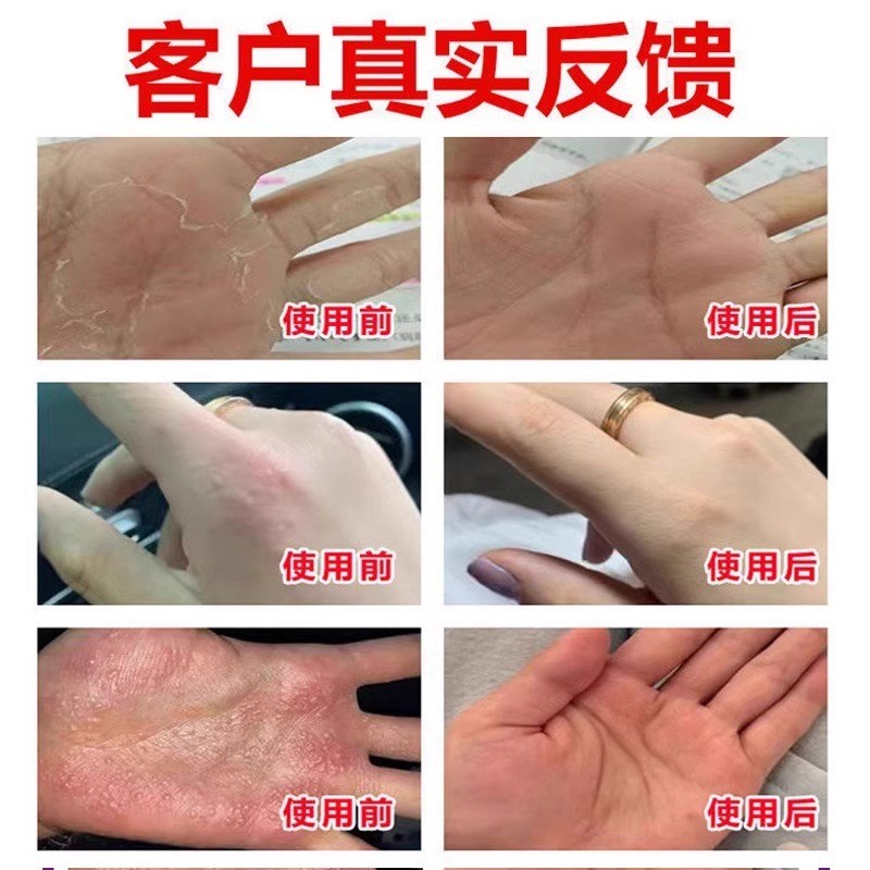 告别手脚瘙痒，专治掌趾脓包病的神奇药膏，你值得拥有！✨